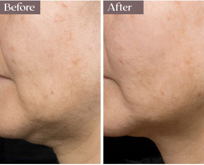 thermage before after nyc